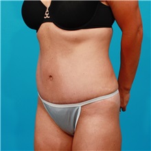Tummy Tuck After Photo by Michael Bogdan, MD, MBA, FACS; Grapevine, TX - Case 31978