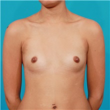 Breast Augmentation Before Photo by Michael Bogdan, MD, MBA, FACS; Grapevine, TX - Case 31979