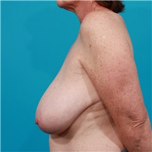 Breast Reduction Before Photo by Michael Bogdan, MD, MBA, FACS; Grapevine, TX - Case 31989
