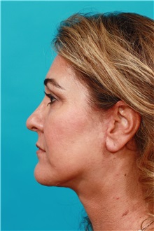 Facelift After Photo by Michael Bogdan, MD, MBA, FACS; Grapevine, TX - Case 31992