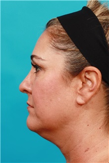 Facelift Before Photo by Michael Bogdan, MD, MBA, FACS; Grapevine, TX - Case 31992