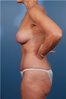 Tummy Tuck After Photo by Michael Bogdan, MD, MBA, FACS; Grapevine, TX - Case 31993