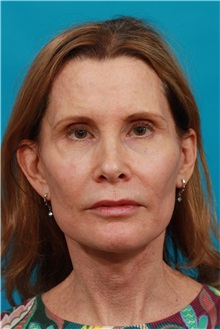 Facelift After Photo by Michael Bogdan, MD, MBA, FACS; Grapevine, TX - Case 31995