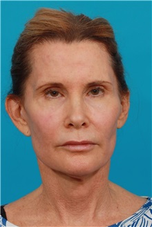 Facelift Before Photo by Michael Bogdan, MD, MBA, FACS; Grapevine, TX - Case 31995
