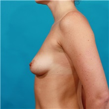Breast Augmentation Before Photo by Michael Bogdan, MD, MBA, FACS; Grapevine, TX - Case 31998