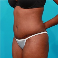 Tummy Tuck After Photo by Michael Bogdan, MD, MBA, FACS; Grapevine, TX - Case 32001