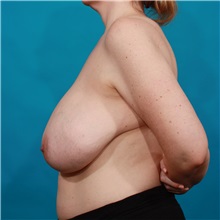 Breast Reduction Before Photo by Michael Bogdan, MD, MBA, FACS; Grapevine, TX - Case 32002