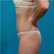 Tummy Tuck After Photo by Michael Bogdan, MD, MBA, FACS; Grapevine, TX - Case 32003