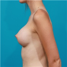 Breast Augmentation After Photo by Michael Bogdan, MD, MBA, FACS; Grapevine, TX - Case 32005