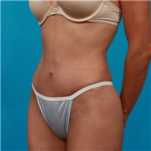 Tummy Tuck After Photo by Michael Bogdan, MD, MBA, FACS; Grapevine, TX - Case 32009