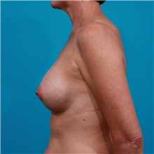 Breast Augmentation After Photo by Michael Bogdan, MD, MBA, FACS; Grapevine, TX - Case 32015