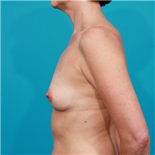 Breast Augmentation Before Photo by Michael Bogdan, MD, MBA, FACS; Grapevine, TX - Case 32015