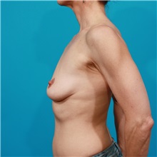 Breast Augmentation Before Photo by Michael Bogdan, MD, MBA, FACS; Grapevine, TX - Case 32019