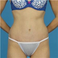 Tummy Tuck After Photo by Michael Bogdan, MD, MBA, FACS; Grapevine, TX - Case 32020