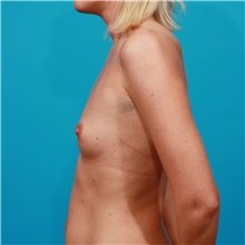 Breast Augmentation Before Photo by Michael Bogdan, MD, MBA, FACS; Grapevine, TX - Case 32023