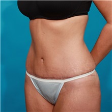 Tummy Tuck After Photo by Michael Bogdan, MD, MBA, FACS; Grapevine, TX - Case 32034
