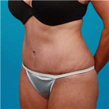 Tummy Tuck After Photo by Michael Bogdan, MD, MBA, FACS; Grapevine, TX - Case 32041