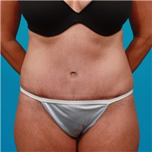 Tummy Tuck After Photo by Michael Bogdan, MD, MBA, FACS; Grapevine, TX - Case 32041
