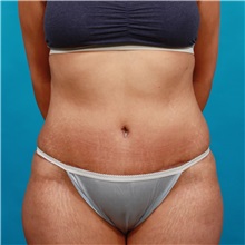 Tummy Tuck After Photo by Michael Bogdan, MD, MBA, FACS; Grapevine, TX - Case 32046