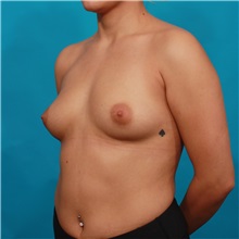 Breast Augmentation Before Photo by Michael Bogdan, MD, MBA, FACS; Grapevine, TX - Case 32049