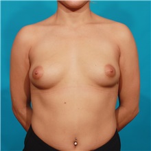 Breast Augmentation Before Photo by Michael Bogdan, MD, MBA, FACS; Grapevine, TX - Case 32049