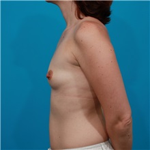 Breast Augmentation Before Photo by Michael Bogdan, MD, MBA, FACS; Grapevine, TX - Case 32056