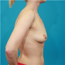 Breast Augmentation Before Photo by Michael Bogdan, MD, MBA, FACS; Grapevine, TX - Case 32057
