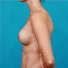 Breast Augmentation After Photo by Michael Bogdan, MD, MBA, FACS; Grapevine, TX - Case 32061