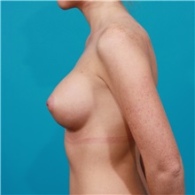 Breast Augmentation After Photo by Michael Bogdan, MD, MBA, FACS; Grapevine, TX - Case 32062