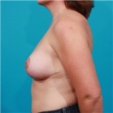 Breast Lift After Photo by Michael Bogdan, MD, MBA, FACS; Grapevine, TX - Case 32068