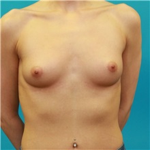 Breast Augmentation Before Photo by Michael Bogdan, MD, MBA, FACS; Grapevine, TX - Case 32071
