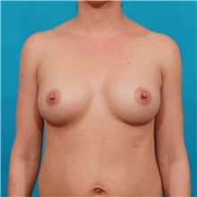 Breast Augmentation After Photo by Michael Bogdan, MD, MBA, FACS; Grapevine, TX - Case 32073