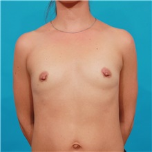Breast Augmentation Before Photo by Michael Bogdan, MD, MBA, FACS; Grapevine, TX - Case 32073