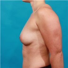 Breast Augmentation Before Photo by Michael Bogdan, MD, MBA, FACS; Grapevine, TX - Case 32080