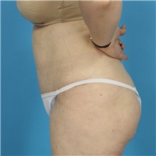 Tummy Tuck After Photo by Michael Bogdan, MD, MBA, FACS; Grapevine, TX - Case 32084