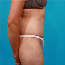 Tummy Tuck After Photo by Michael Bogdan, MD, MBA, FACS; Grapevine, TX - Case 32086