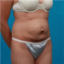 Tummy Tuck Before Photo by Michael Bogdan, MD, MBA, FACS; Grapevine, TX - Case 32086