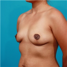 Breast Lift After Photo by Michael Bogdan, MD, MBA, FACS; Grapevine, TX - Case 32087