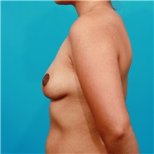 Breast Lift After Photo by Michael Bogdan, MD, MBA, FACS; Grapevine, TX - Case 32087