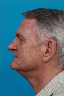 Facelift Before Photo by Michael Bogdan, MD, MBA, FACS; Grapevine, TX - Case 32088