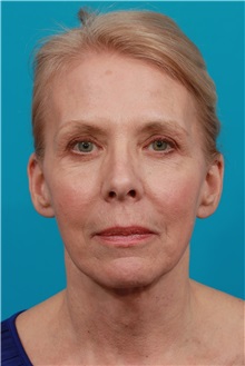 Facelift After Photo by Michael Bogdan, MD, MBA, FACS; Grapevine, TX - Case 32090