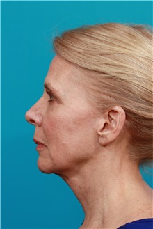 Facelift After Photo by Michael Bogdan, MD, MBA, FACS; Grapevine, TX - Case 32090