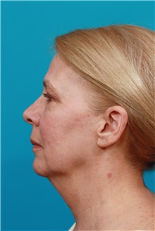 Facelift Before Photo by Michael Bogdan, MD, MBA, FACS; Grapevine, TX - Case 32090