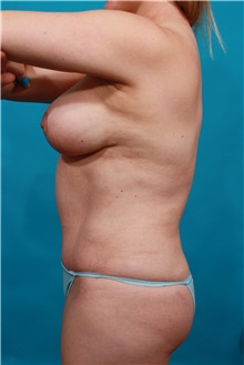Tummy Tuck After Photo by Michael Bogdan, MD, MBA, FACS; Grapevine, TX - Case 32242