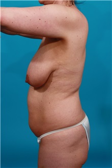 Tummy Tuck Before Photo by Michael Bogdan, MD, MBA, FACS; Grapevine, TX - Case 32248