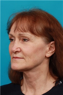 Facelift After Photo by Michael Bogdan, MD, MBA, FACS; Grapevine, TX - Case 32250