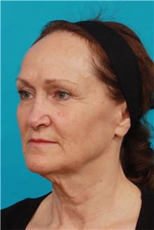 Facelift Before Photo by Michael Bogdan, MD, MBA, FACS; Grapevine, TX - Case 32250