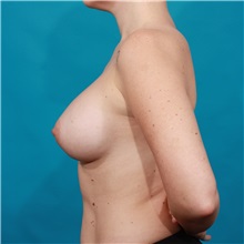 Breast Augmentation After Photo by Michael Bogdan, MD, MBA, FACS; Grapevine, TX - Case 32251