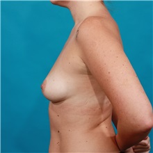 Breast Augmentation Before Photo by Michael Bogdan, MD, MBA, FACS; Grapevine, TX - Case 32251