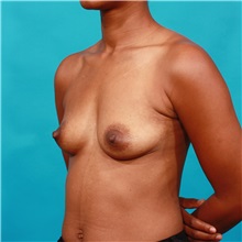 Breast Augmentation Before Photo by Michael Bogdan, MD, MBA, FACS; Grapevine, TX - Case 32252